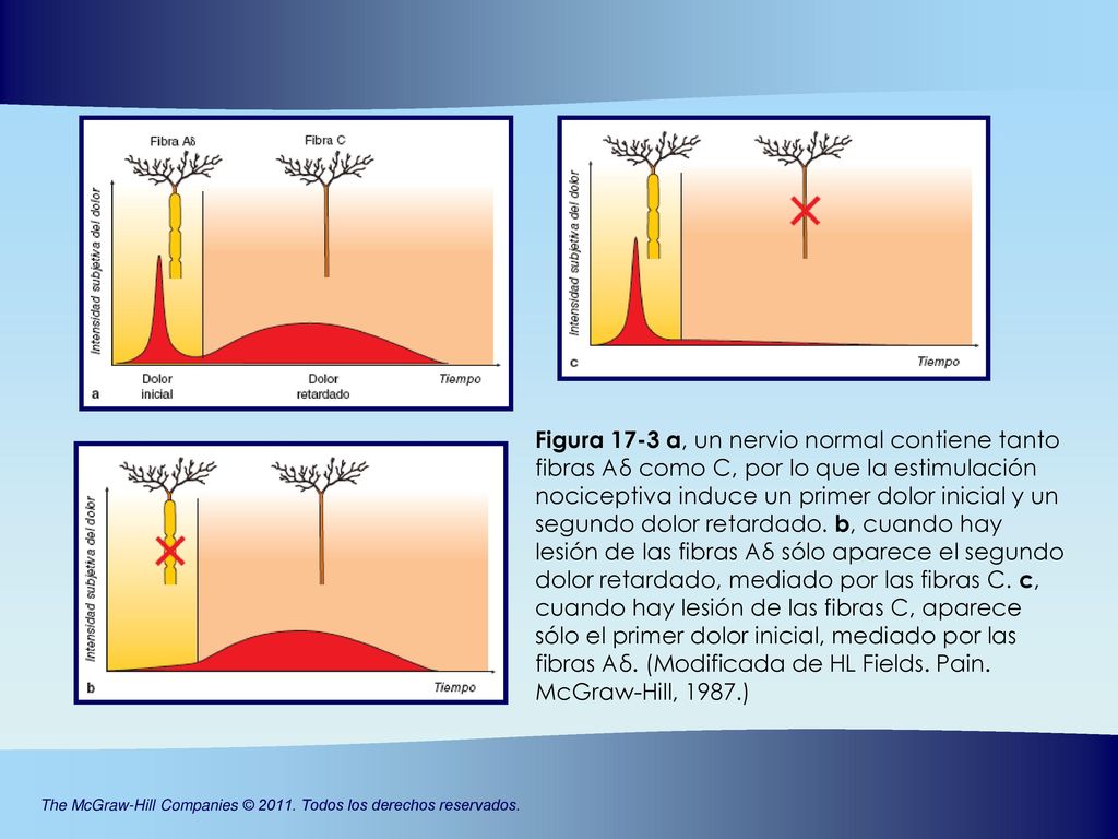 Figura 17-3 a, un nervio normal contiene tanto fibras Aδ como C, por lo que la estimulación nociceptiva induce un primer dolor inicial y un segundo dolor retardado.