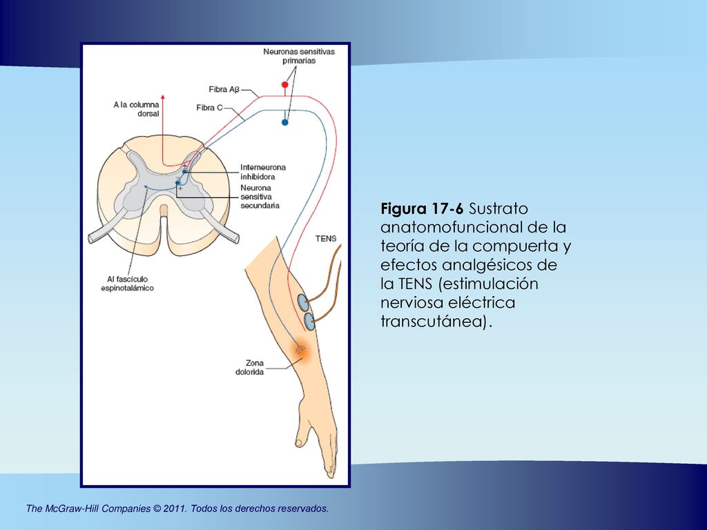 Figura 17-6 Sustrato anatomofuncional de la teoría de la compuerta y efectos analgésicos de la TENS (estimulación nerviosa eléctrica transcutánea).