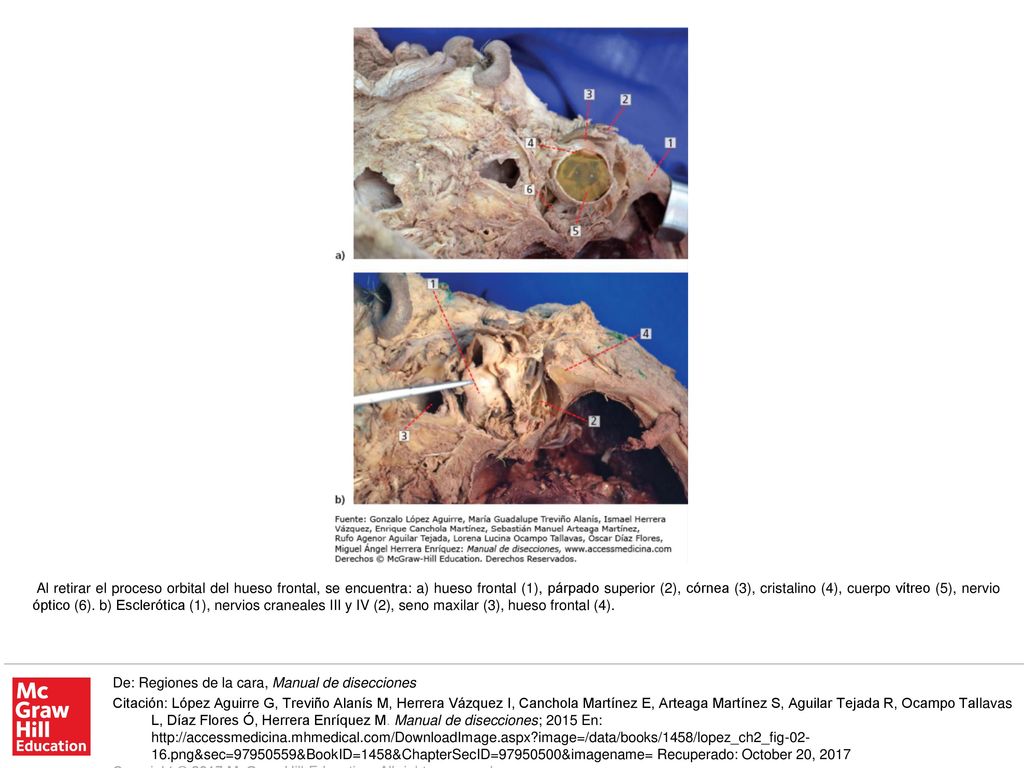 Al retirar el proceso orbital del hueso frontal, se encuentra: a) hueso frontal (1), párpado superior (2), córnea (3), cristalino (4), cuerpo vítreo (5), nervio óptico (6). b) Esclerótica (1), nervios craneales III y IV (2), seno maxilar (3), hueso frontal (4).