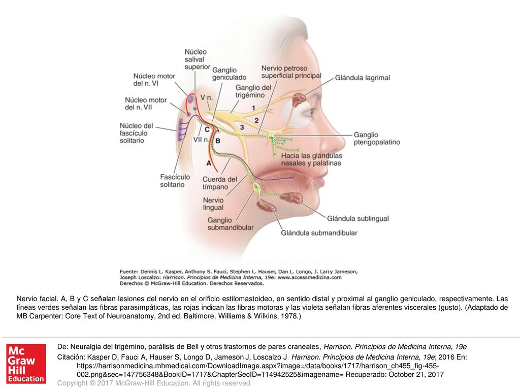 Nervio facial. A, B y C señalan lesiones del nervio en el orificio estilomastoideo, en sentido distal y proximal al ganglio geniculado, respectivamente. Las líneas verdes señalan las fibras parasimpáticas, las rojas indican las fibras motoras y las violeta señalan fibras aferentes viscerales (gusto). (Adaptado de MB Carpenter: Core Text of Neuroanatomy, 2nd ed. Baltimore, Williams & Wilkins, 1978.)