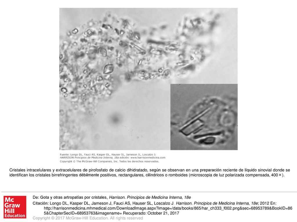 Cristales intracelulares y extracelulares de pirofosfato de calcio dihidratado, según se observan en una preparación reciente de líquido sinovial donde se identifican los cristales birrefringentes débilmente positivos, rectangulares, cilíndricos o romboides (microscopia de luz polarizada compensada, 400×).