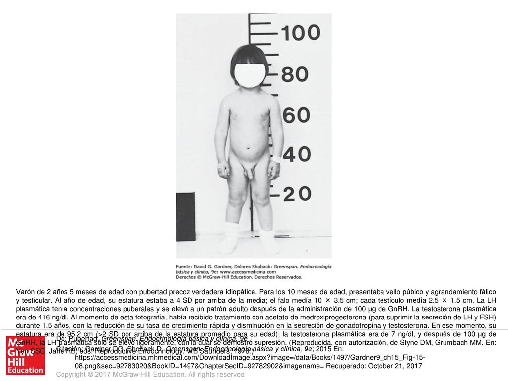 Varón de 2 años 5 meses de edad con pubertad precoz verdadera idiopática. Para los 10 meses de edad, presentaba vello púbico y agrandamiento fálico y testicular. Al año de edad, su estatura estaba a 4 SD por arriba de la media; el falo medía 10 × 3.5 cm; cada testículo medía 2.5 × 1.5 cm. La LH plasmática tenía concentraciones puberales y se elevó a un patrón adulto después de la administración de 100 μg de GnRH. La testosterona plasmática era de 416 ng/dl. Al momento de esta fotografía, había recibido tratamiento con acetato de medroxiprogesterona (para suprimir la secreción de LH y FSH) durante 1.5 años, con la reducción de su tasa de crecimiento rápida y disminución en la secreción de gonadotropina y testosterona. En ese momento, su estatura era de 95.2 cm (>2 SD por arriba de la estatura promedio para su edad); la testosterona plasmática era de 7 ng/dl, y después de 100 μg de GnRH, la LH plasmática sólo se elevó ligeramente, con lo cual se demostró supresión. (Reproducida, con autorización, de Styne DM, Grumbach MM. En: Yen SSC, Jaffe RB, eds. Reproductive Endocrinology. WB Saunders; 1978.)