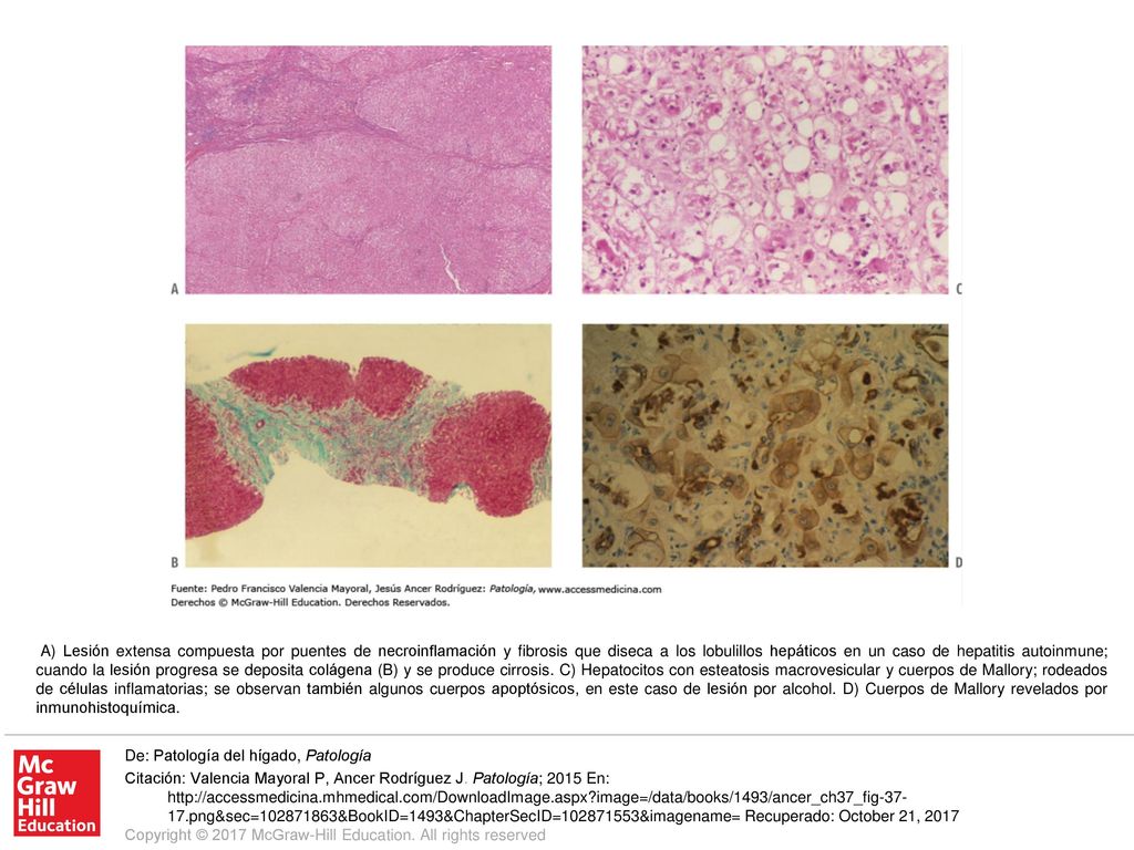 A) Lesión extensa compuesta por puentes de necroinflamación y fibrosis que diseca a los lobulillos hepáticos en un caso de hepatitis autoinmune; cuando la lesión progresa se deposita colágena (B) y se produce cirrosis. C) Hepatocitos con esteatosis macrovesicular y cuerpos de Mallory; rodeados de células inflamatorias; se observan también algunos cuerpos apoptósicos, en este caso de lesión por alcohol. D) Cuerpos de Mallory revelados por inmunohistoquímica.