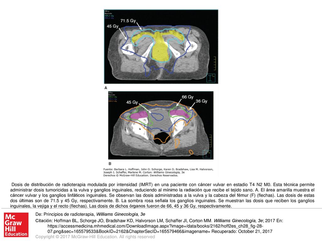 Dosis de distribución de radioterapia modulada por intensidad (IMRT) en una paciente con cáncer vulvar en estadio T4 N2 M0. Esta técnica permite administrar dosis tumoricidas a la vulva y ganglios inguinales, reduciendo al mínimo la radiación que recibe el tejido sano. A. El área amarilla muestra el cáncer vulvar y los ganglios linfáticos inguinales. Se observan las dosis administradas a la vulva y la cabeza del fémur (F) (flechas). Las dosis de estas dos últimas son de 71.5 y 45 Gy, respectivamente. B. La sombra rosa señala los ganglios inguinales. Se muestran las dosis que reciben los ganglios inguinales, la vejiga y el recto (flechas). Las dosis de dichos órganos fueron de 66, 45 y 36 Gy, respectivamente.