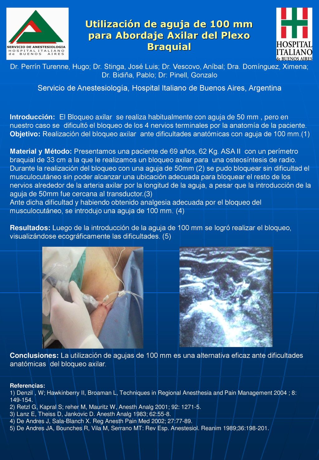 Utilización de aguja de 100 mm para Abordaje Axilar del Plexo Braquial