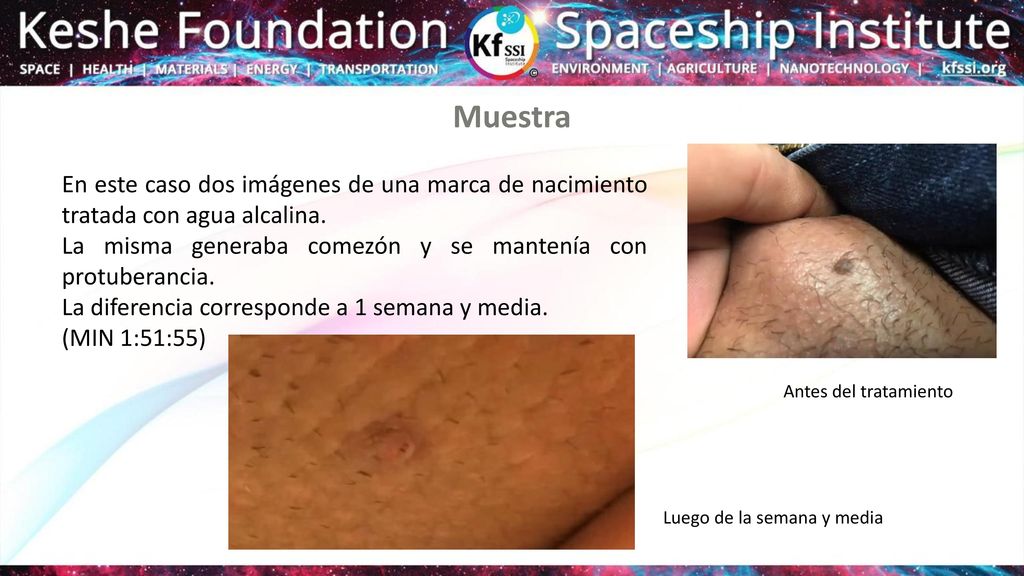 Muestra En este caso dos imágenes de una marca de nacimiento tratada con agua alcalina. La misma generaba comezón y se mantenía con protuberancia.