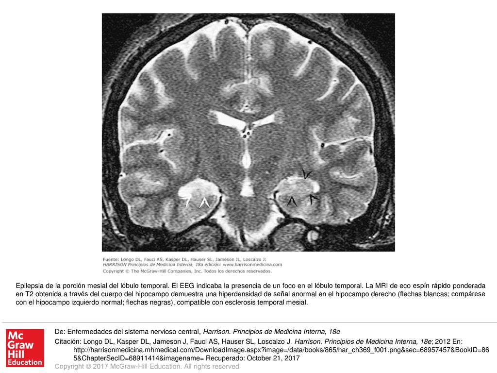 Epilepsia de la porción mesial del lóbulo temporal