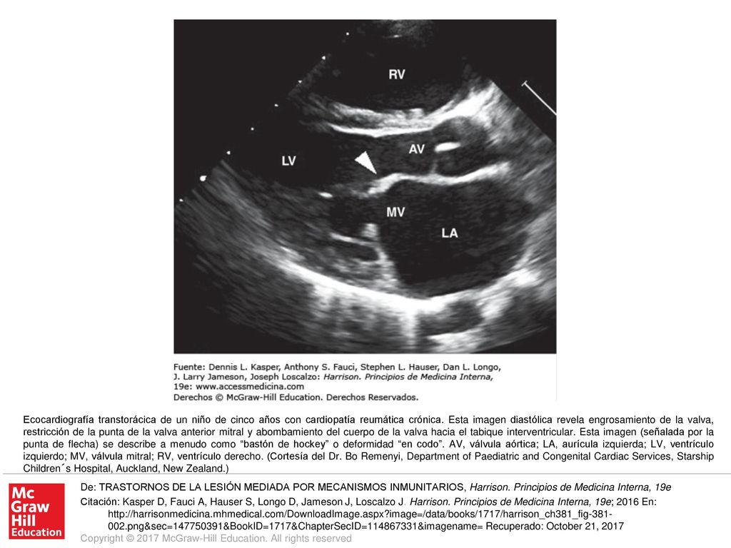 Ecocardiografía transtorácica de un niño de cinco años con cardiopatía reumática crónica. Esta imagen diastólica revela engrosamiento de la valva, restricción de la punta de la valva anterior mitral y abombamiento del cuerpo de la valva hacia el tabique interventricular. Esta imagen (señalada por la punta de flecha) se describe a menudo como bastón de hockey o deformidad en codo . AV, válvula aórtica; LA, aurícula izquierda; LV, ventrículo izquierdo; MV, válvula mitral; RV, ventrículo derecho. (Cortesía del Dr. Bo Remenyi, Department of Paediatric and Congenital Cardiac Services, Starship Children´s Hospital, Auckland, New Zealand.)
