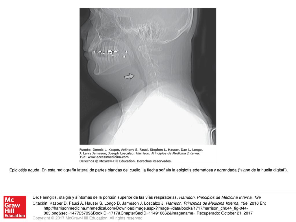 Epiglotitis aguda. En esta radiografía lateral de partes blandas del cuello, la flecha señala la epiglotis edematosa y agrandada ( signo de la huella digital ).