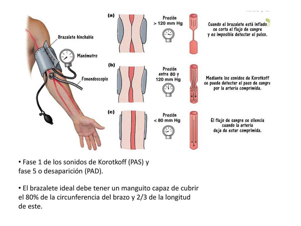 Fase 1 de los sonidos de Korotkoff (PAS) y fase 5 o desaparición (PAD).
