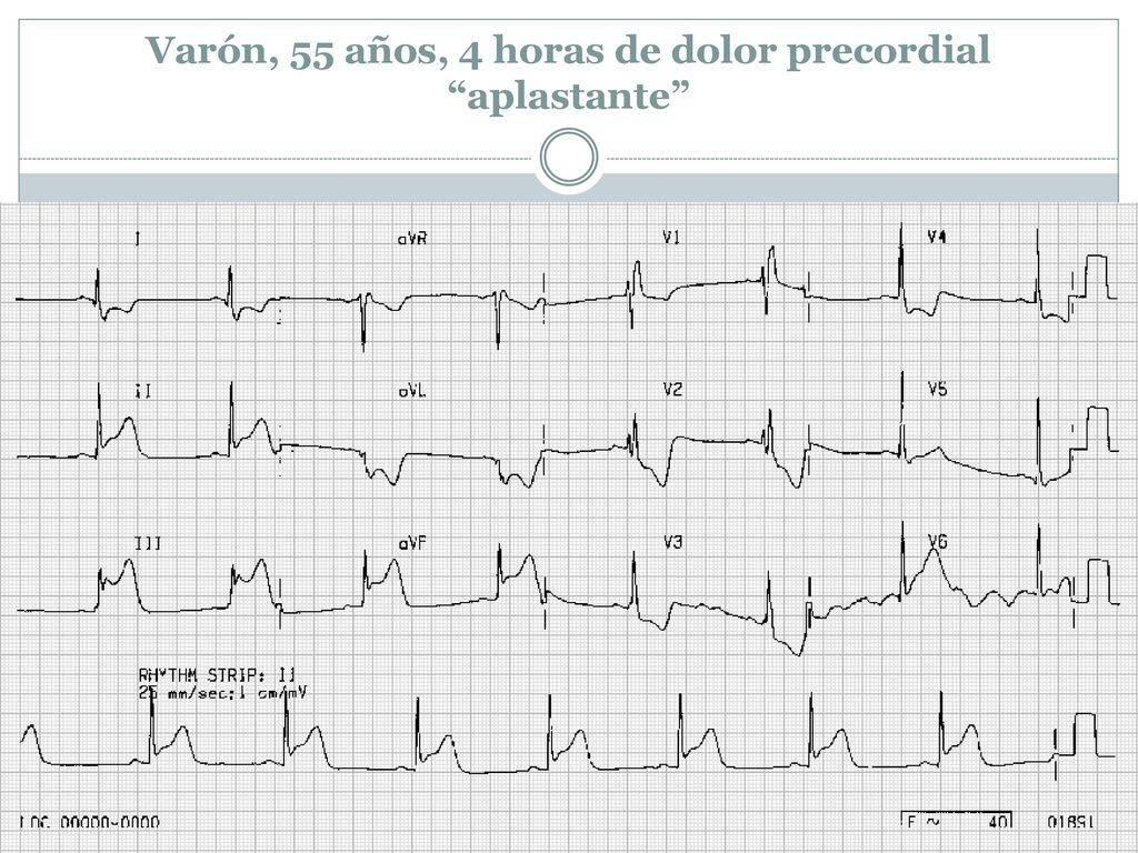 Varón, 55 años, 4 horas de dolor precordial aplastante
