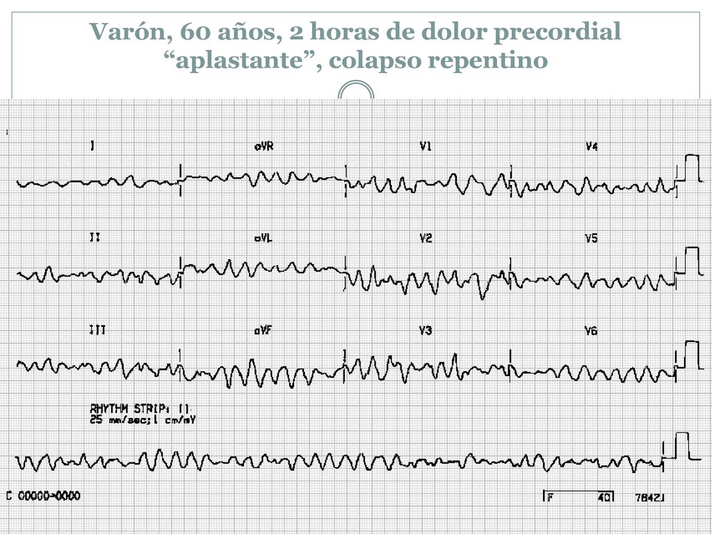 Varón, 60 años, 2 horas de dolor precordial aplastante , colapso repentino