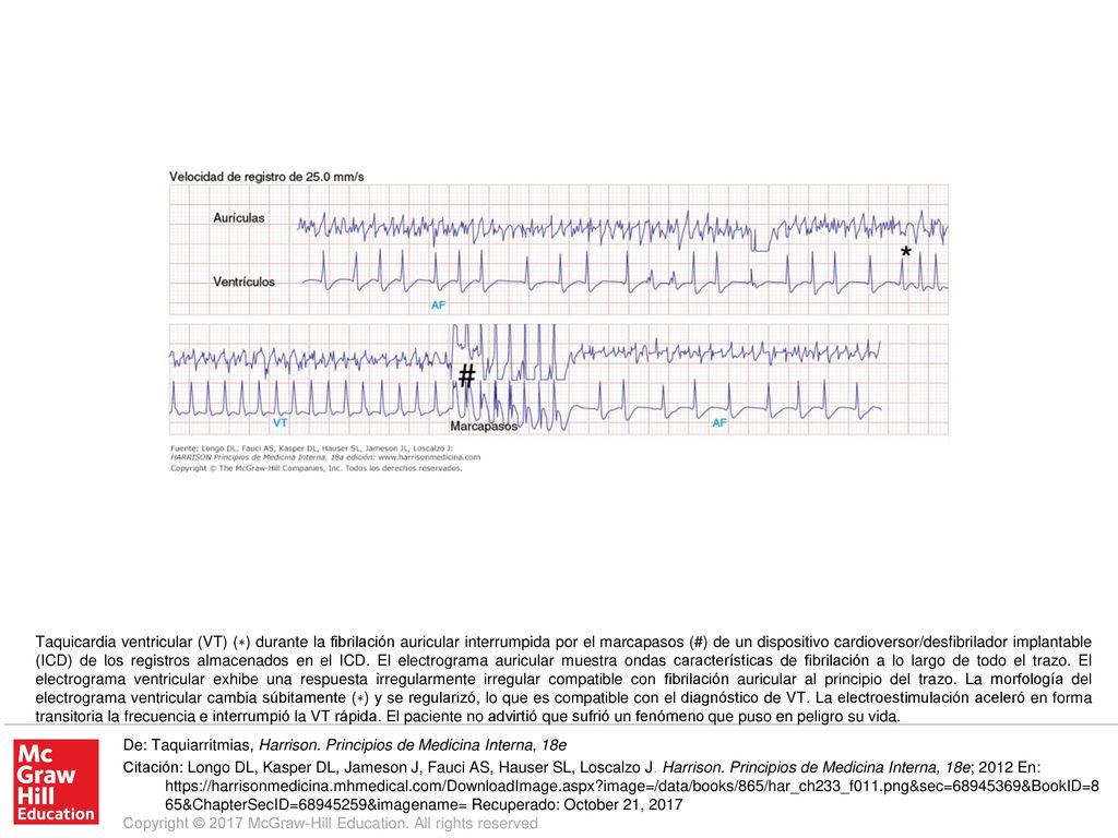 Taquicardia ventricular (VT) (∗) durante la fibrilación auricular interrumpida por el marcapasos (#) de un dispositivo cardioversor/desfibrilador implantable (ICD) de los registros almacenados en el ICD. El electrograma auricular muestra ondas características de fibrilación a lo largo de todo el trazo. El electrograma ventricular exhibe una respuesta irregularmente irregular compatible con fibrilación auricular al principio del trazo. La morfología del electrograma ventricular cambia súbitamente (∗) y se regularizó, lo que es compatible con el diagnóstico de VT. La electroestimulación aceleró en forma transitoria la frecuencia e interrumpió la VT rápida. El paciente no advirtió que sufrió un fenómeno que puso en peligro su vida.