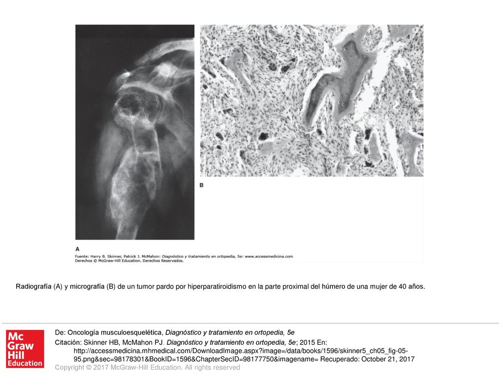 Radiografía (A) y micrografía (B) de un tumor pardo por hiperparatiroidismo en la parte proximal del húmero de una mujer de 40 años.