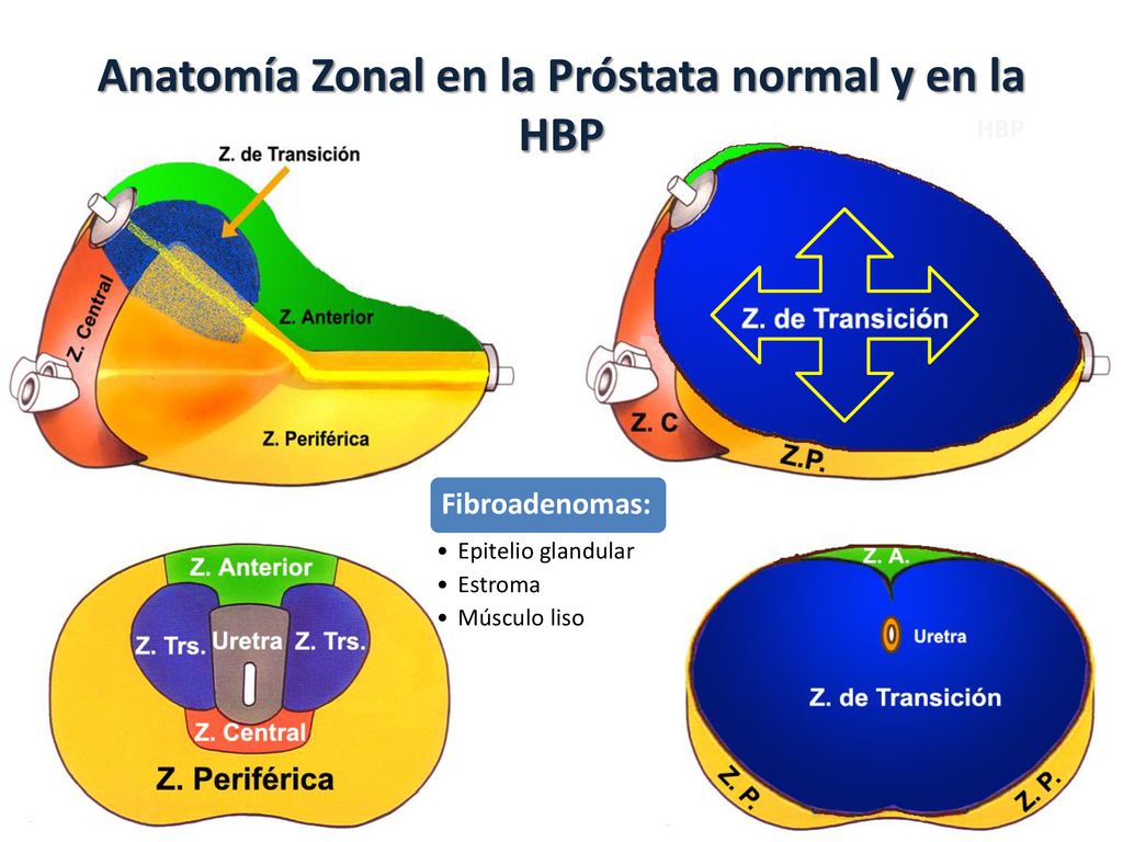 Anatomía Zonal en la Próstata normal y en la HBP