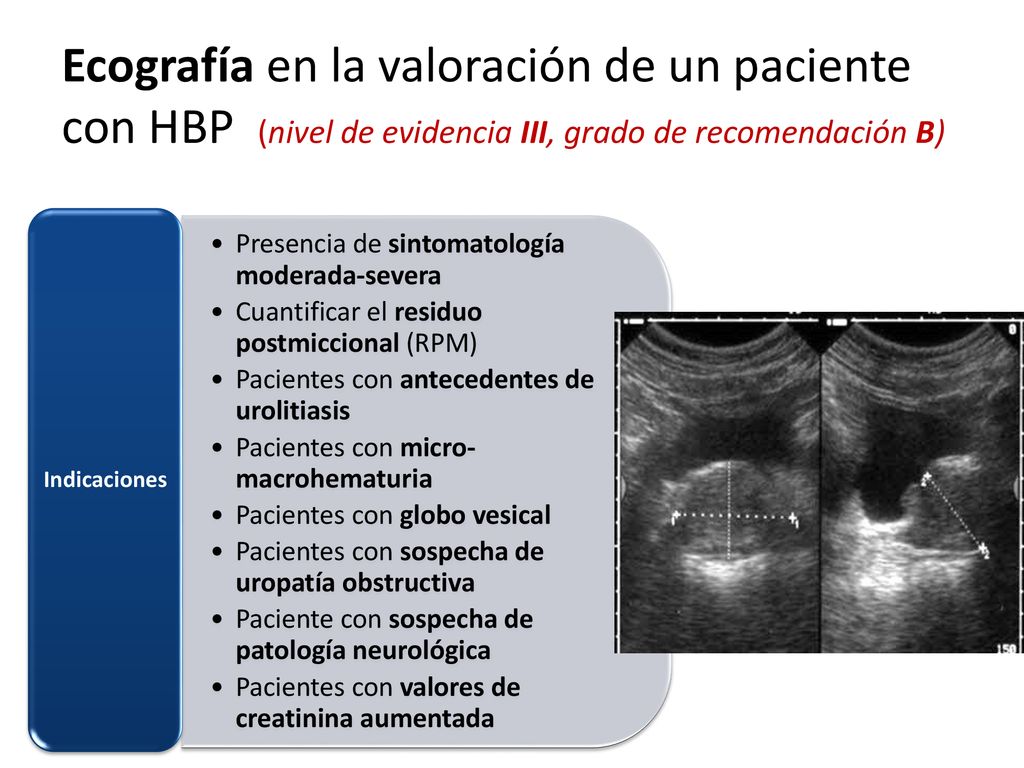 Ecografía en la valoración de un paciente con HBP (nivel de evidencia III, grado de recomendación B)