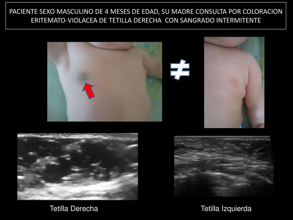 PACIENTE SEXO MASCULINO DE 4 MESES DE EDAD, SU MADRE CONSULTA POR COLORACION ERITEMATO-VIOLACEA DE TETILLA DERECHA CON SANGRADO INTERMITENTE