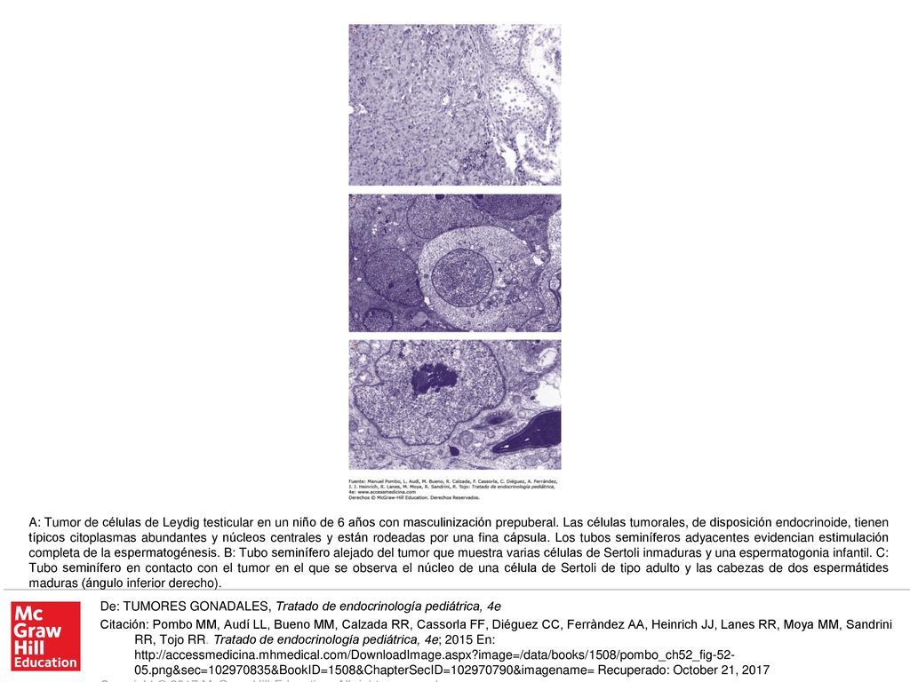 A: Tumor de células de Leydig testicular en un niño de 6 años con masculinización prepuberal. Las células tumorales, de disposición endocrinoide, tienen típicos citoplasmas abundantes y núcleos centrales y están rodeadas por una fina cápsula. Los tubos seminíferos adyacentes evidencian estimulación completa de la espermatogénesis. B: Tubo seminífero alejado del tumor que muestra varias células de Sertoli inmaduras y una espermatogonia infantil. C: Tubo seminífero en contacto con el tumor en el que se observa el núcleo de una célula de Sertoli de tipo adulto y las cabezas de dos espermátides maduras (ángulo inferior derecho).