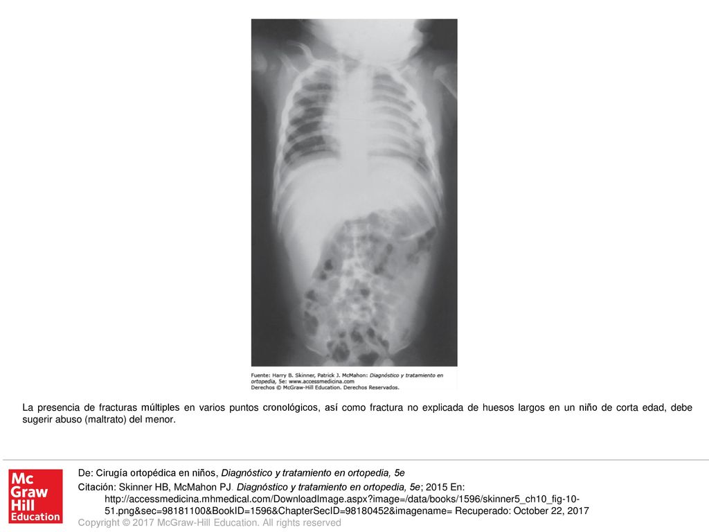 La presencia de fracturas múltiples en varios puntos cronológicos, así como fractura no explicada de huesos largos en un niño de corta edad, debe sugerir abuso (maltrato) del menor.