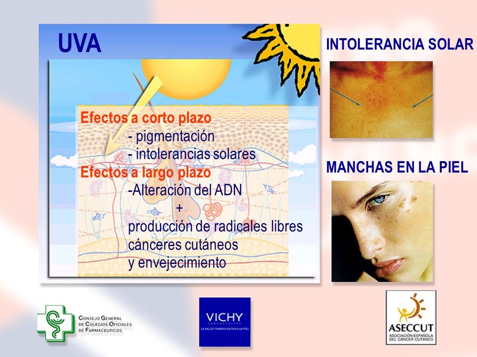 UVA INTOLERANCIA SOLAR Efectos a corto plazo - pigmentación