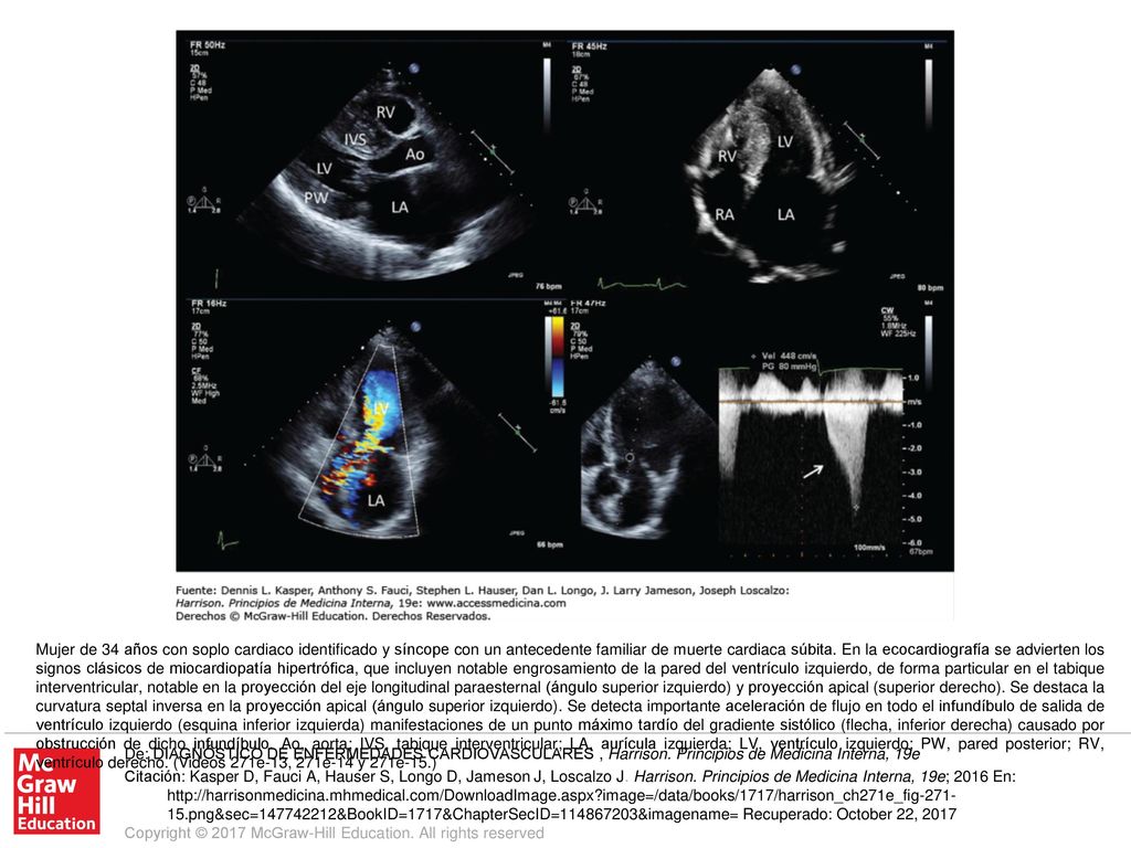 Mujer de 34 años con soplo cardiaco identificado y síncope con un antecedente familiar de muerte cardiaca súbita. En la ecocardiografía se advierten los signos clásicos de miocardiopatía hipertrófica, que incluyen notable engrosamiento de la pared del ventrículo izquierdo, de forma particular en el tabique interventricular, notable en la proyección del eje longitudinal paraesternal (ángulo superior izquierdo) y proyección apical (superior derecho). Se destaca la curvatura septal inversa en la proyección apical (ángulo superior izquierdo). Se detecta importante aceleración de flujo en todo el infundíbulo de salida de ventrículo izquierdo (esquina inferior izquierda) manifestaciones de un punto máximo tardío del gradiente sistólico (flecha, inferior derecha) causado por obstrucción de dicho infundíbulo. Ao, aorta; IVS, tabique interventricular; LA, aurícula izquierda; LV, ventrículo izquierdo; PW, pared posterior; RV, ventrículo derecho. (Videos 271e-13, 271e-14 y 271e-15.)