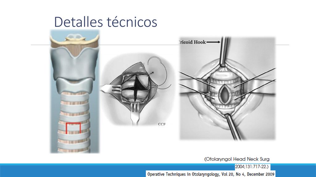 Detalles técnicos No hay un tipo de incisión en traquea que se amejor en terminos de las complicaciones.