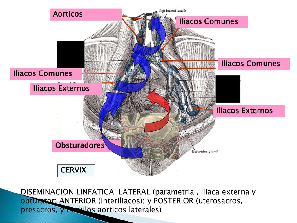 Aorticos Iliacos Comunes. Iliacos Comunes. Iliacos Comunes. Iliacos Externos. Iliacos Externos.