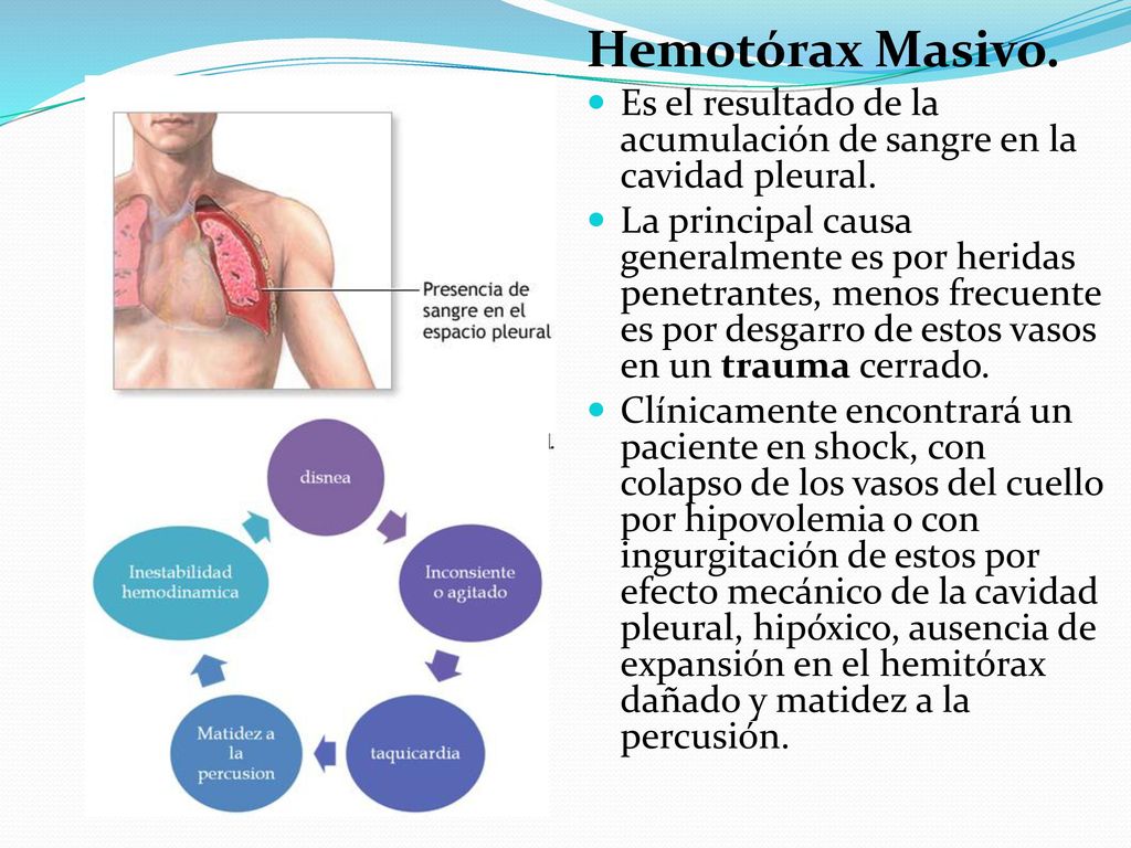 Hemotórax Masivo. Es el resultado de la acumulación de sangre en la cavidad pleural.