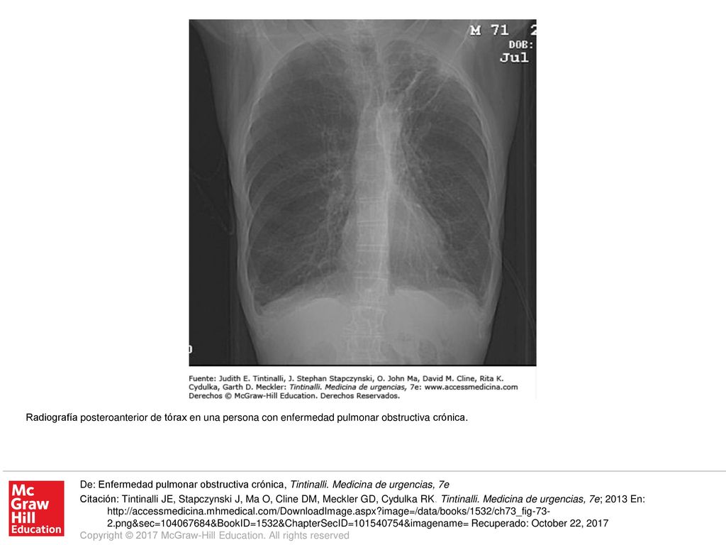 Radiografía posteroanterior de tórax en una persona con enfermedad pulmonar obstructiva crónica.