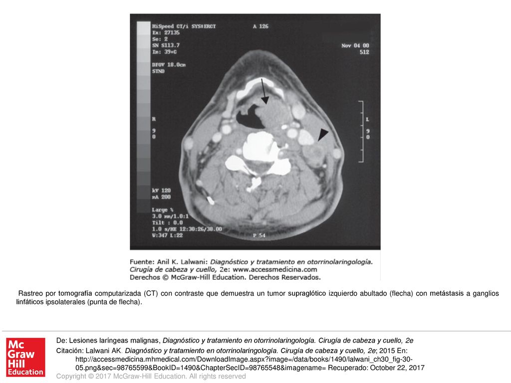 Rastreo por tomografía computarizada (CT) con contraste que demuestra un tumor supraglótico izquierdo abultado (flecha) con metástasis a ganglios linfáticos ipsolaterales (punta de flecha).