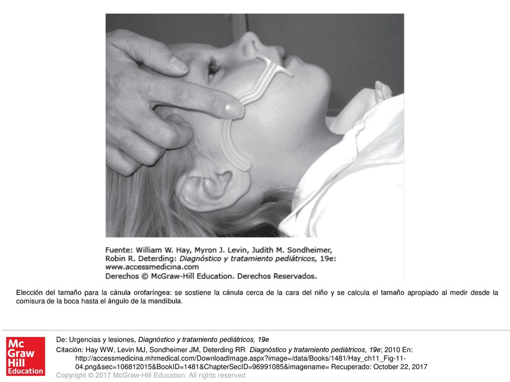 Elección del tamaño para la cánula orofaríngea: se sostiene la cánula cerca de la cara del niño y se calcula el tamaño apropiado al medir desde la comisura de la boca hasta el ángulo de la mandíbula.