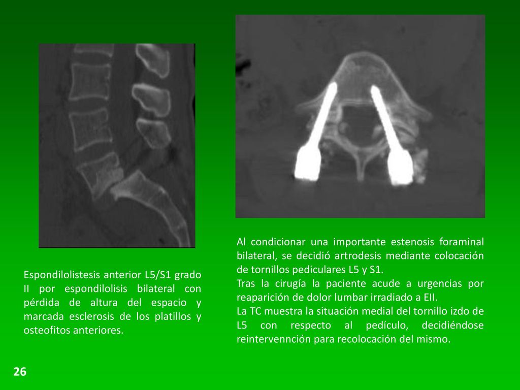 Al condicionar una importante estenosis foraminal bilateral, se decidió artrodesis mediante colocación de tornillos pediculares L5 y S1.