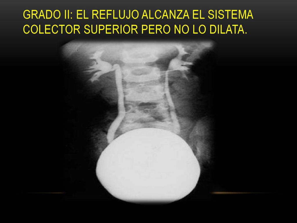 Grado II: el reflujo alcanza el sistema colector superior pero no lo dilata.