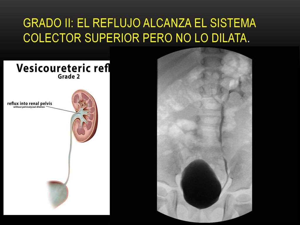 Grado II: el reflujo alcanza el sistema colector superior pero no lo dilata.