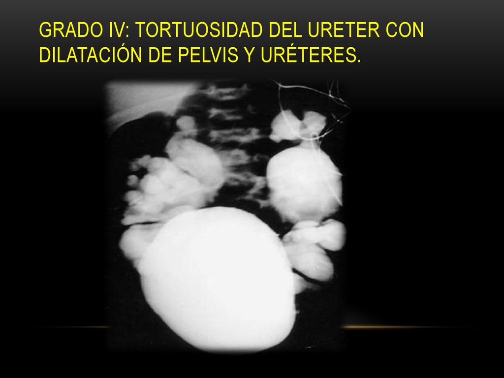 Grado IV: tortuosidad del ureter con dilatación de pelvis y uréteres.