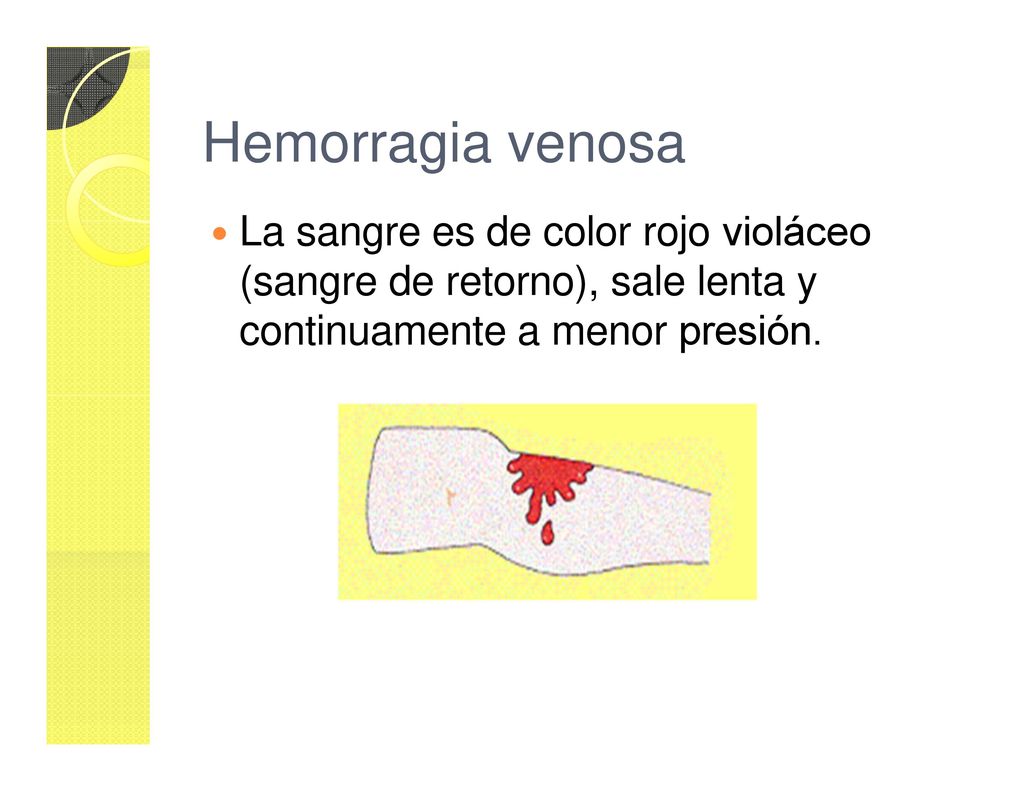 Hemorragia venosa La sangre es de color rojo violáceo (sangre de retorno), sale lenta y continuamente a menor presión.