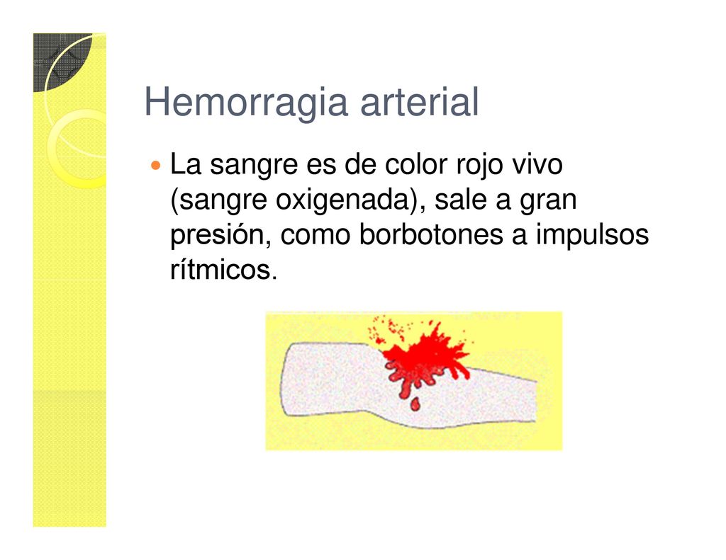 Hemorragia arterial La sangre es de color rojo vivo (sangre oxigenada), sale a gran presión, como borbotones a impulsos rítmicos.