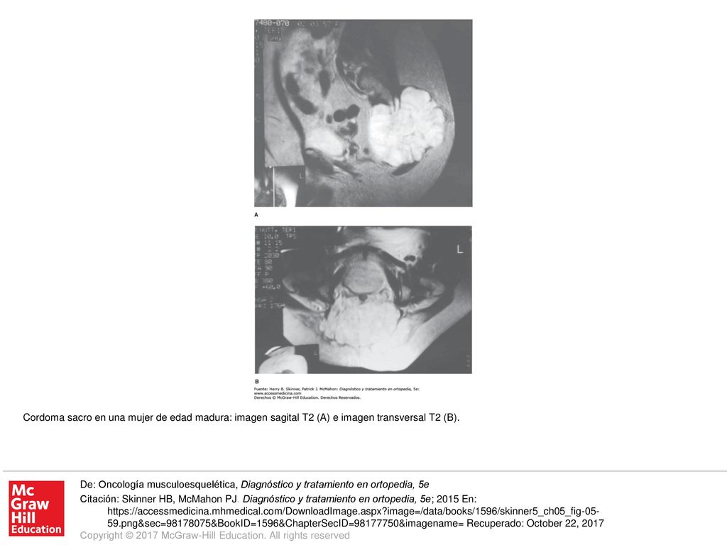 Cordoma sacro en una mujer de edad madura: imagen sagital T2 (A) e imagen transversal T2 (B).