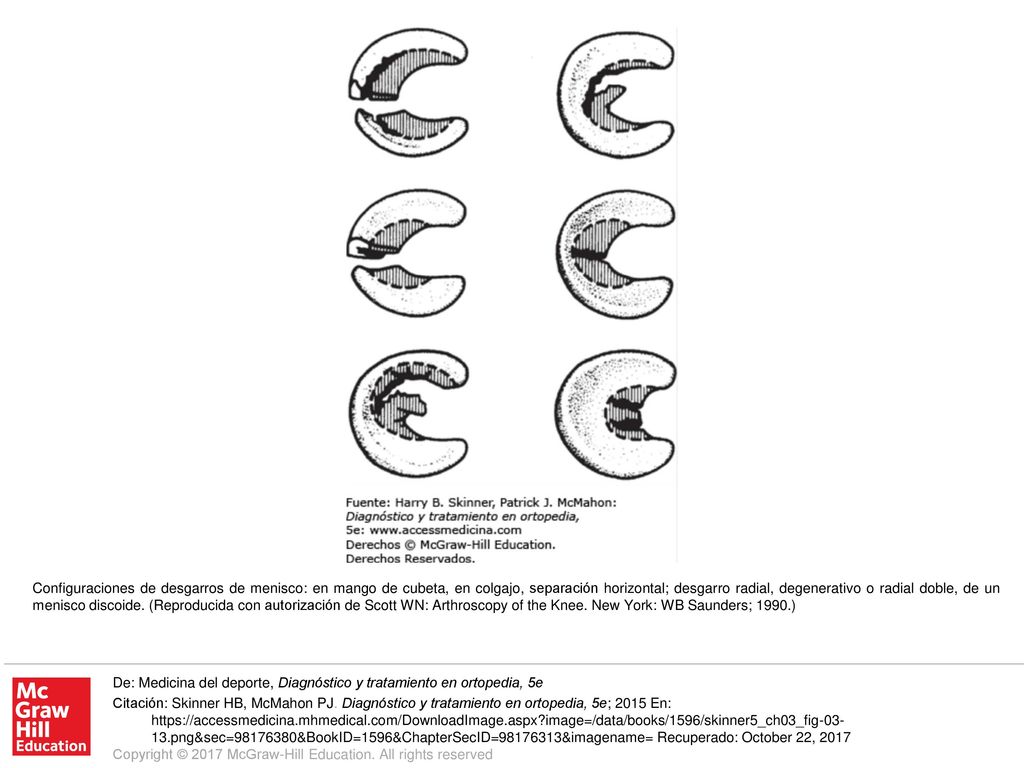 Configuraciones de desgarros de menisco: en mango de cubeta, en colgajo, separación horizontal; desgarro radial, degenerativo o radial doble, de un menisco discoide. (Reproducida con autorización de Scott WN: Arthroscopy of the Knee. New York: WB Saunders; 1990.)