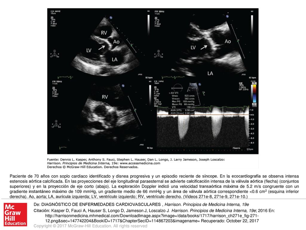 Paciente de 70 años con soplo cardiaco identificado y disnea progresiva y un episodio reciente de síncope. En la ecocardiografía se observa intensa estenosis aórtica calcificada. En las proyecciones del eje longitudinal paraesternal se advierte calcificación intensa de la válvula aórtica (flecha) (conjuntos superiores) y en la proyección de eje corto (abajo). La exploración Doppler indicó una velocidad transaórtica máxima de 5.2 m/s congruente con un gradiente instantáneo máximo de 109 mmHg, un gradiente medio de 66 mmHg y un área de válvula aórtica correspondiente <0.6 cm2 (esquina inferior derecha). Ao, aorta; LA, aurícula izquierda; LV, ventrículo izquierdo; RV, ventrículo derecho. (Videos 271e-8, 271e-9, 271e-10.)