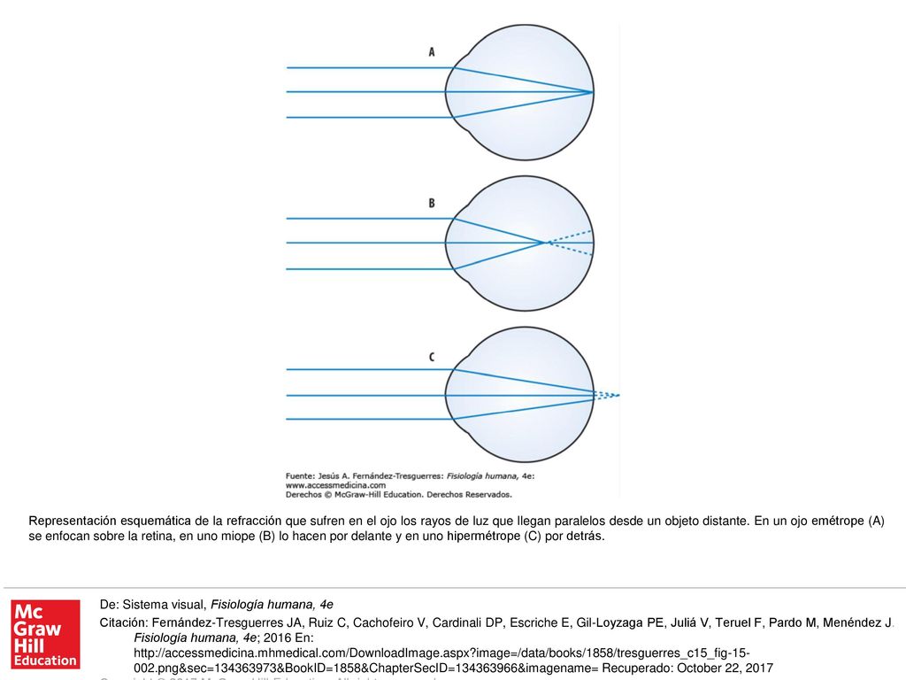 Representación esquemática de la refracción que sufren en el ojo los rayos de luz que llegan paralelos desde un objeto distante. En un ojo emétrope (A) se enfocan sobre la retina, en uno miope (B) lo hacen por delante y en uno hipermétrope (C) por detrás.