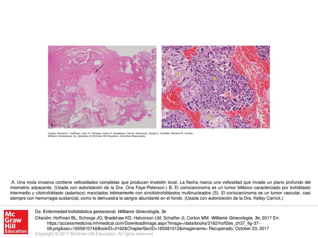 A. Una mola invasiva contiene vellosidades completas que producen invasión local. La flecha marca una vellosidad que invade un plano profundo del miometrio adyacente. (Usada con autorización de la Dra. Ona Faye-Peterson.) B. El coriocarcinoma es un tumor bifásico caracterizado por trofoblasto intermedio y citotrofoblasto (asterisco) mezclados íntimamente con sincitiotrofoblastos multinucleados (S). El coriocarcinoma es un tumor vascular, casi siempre con hemorragia sustancial, como lo demuestra la sangre abundante en el fondo. (Usada con autorización de la Dra. Kelley Carrick.)