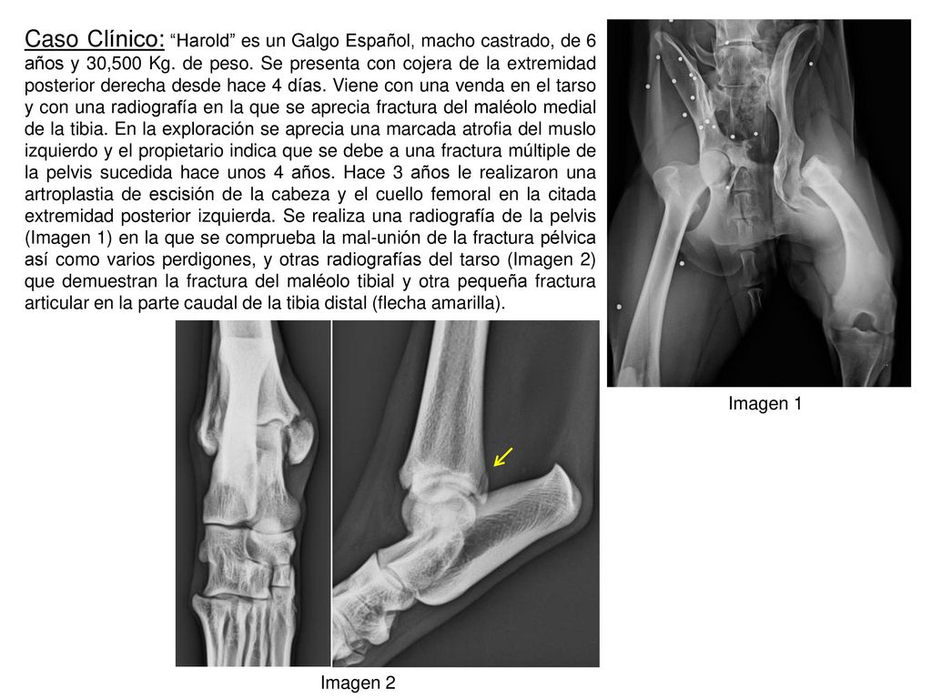 Caso Clínico: Harold es un Galgo Español, macho castrado, de 6 años y 30,500 Kg. de peso. Se presenta con cojera de la extremidad posterior derecha desde hace 4 días. Viene con una venda en el tarso y con una radiografía en la que se aprecia fractura del maléolo medial de la tibia. En la exploración se aprecia una marcada atrofia del muslo izquierdo y el propietario indica que se debe a una fractura múltiple de la pelvis sucedida hace unos 4 años. Hace 3 años le realizaron una artroplastia de escisión de la cabeza y el cuello femoral en la citada extremidad posterior izquierda. Se realiza una radiografía de la pelvis (Imagen 1) en la que se comprueba la mal-unión de la fractura pélvica así como varios perdigones, y otras radiografías del tarso (Imagen 2) que demuestran la fractura del maléolo tibial y otra pequeña fractura articular en la parte caudal de la tibia distal (flecha amarilla).