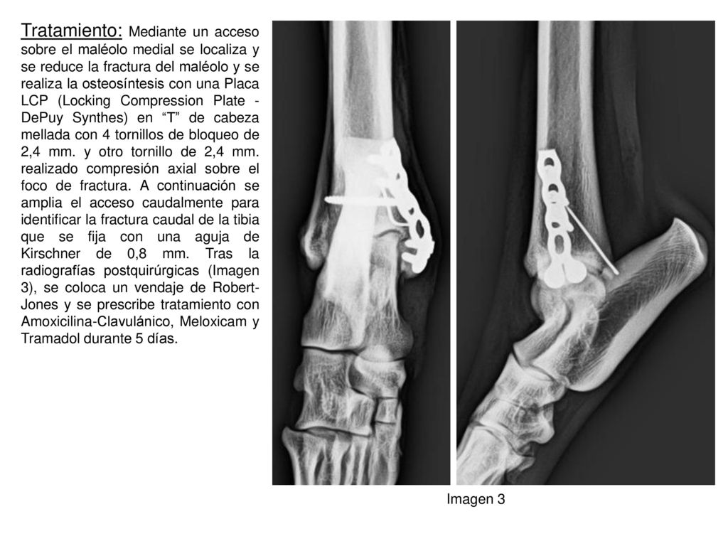Tratamiento: Mediante un acceso sobre el maléolo medial se localiza y se reduce la fractura del maléolo y se realiza la osteosíntesis con una Placa LCP (Locking Compression Plate - DePuy Synthes) en T de cabeza mellada con 4 tornillos de bloqueo de 2,4 mm. y otro tornillo de 2,4 mm. realizado compresión axial sobre el foco de fractura. A continuación se amplia el acceso caudalmente para identificar la fractura caudal de la tibia que se fija con una aguja de Kirschner de 0,8 mm. Tras la radiografías postquirúrgicas (Imagen 3), se coloca un vendaje de Robert-Jones y se prescribe tratamiento con Amoxicilina-Clavulánico, Meloxicam y Tramadol durante 5 días.