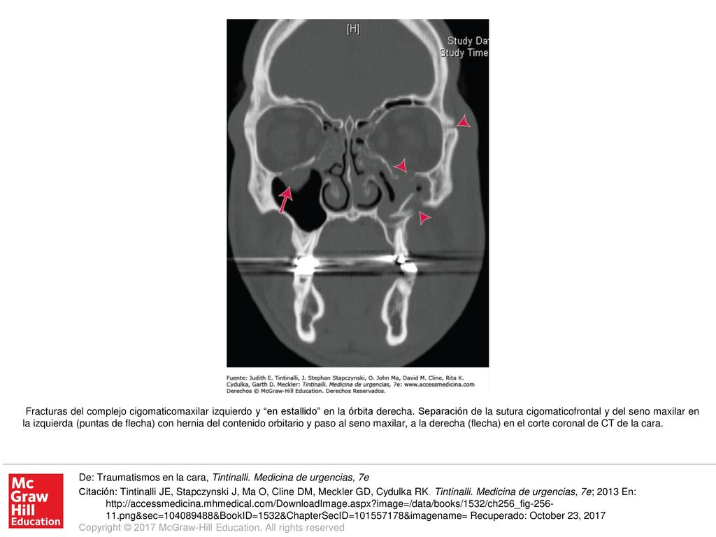 Fracturas del complejo cigomaticomaxilar izquierdo y en estallido en la órbita derecha. Separación de la sutura cigomaticofrontal y del seno maxilar en la izquierda (puntas de flecha) con hernia del contenido orbitario y paso al seno maxilar, a la derecha (flecha) en el corte coronal de CT de la cara.