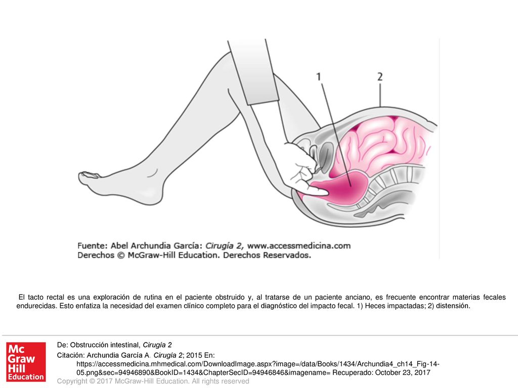 El tacto rectal es una exploración de rutina en el paciente obstruido y, al tratarse de un paciente anciano, es frecuente encontrar materias fecales endurecidas. Esto enfatiza la necesidad del examen clínico completo para el diagnóstico del impacto fecal. 1) Heces impactadas; 2) distensión.
