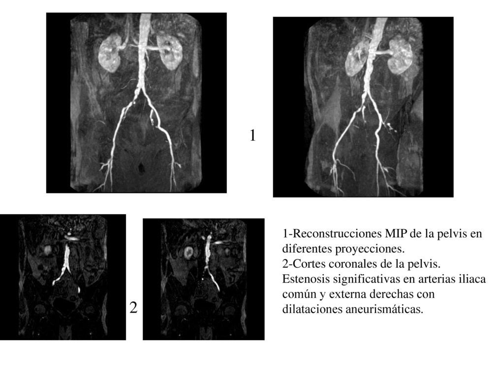 1 2 1-Reconstrucciones MIP de la pelvis en diferentes proyecciones.