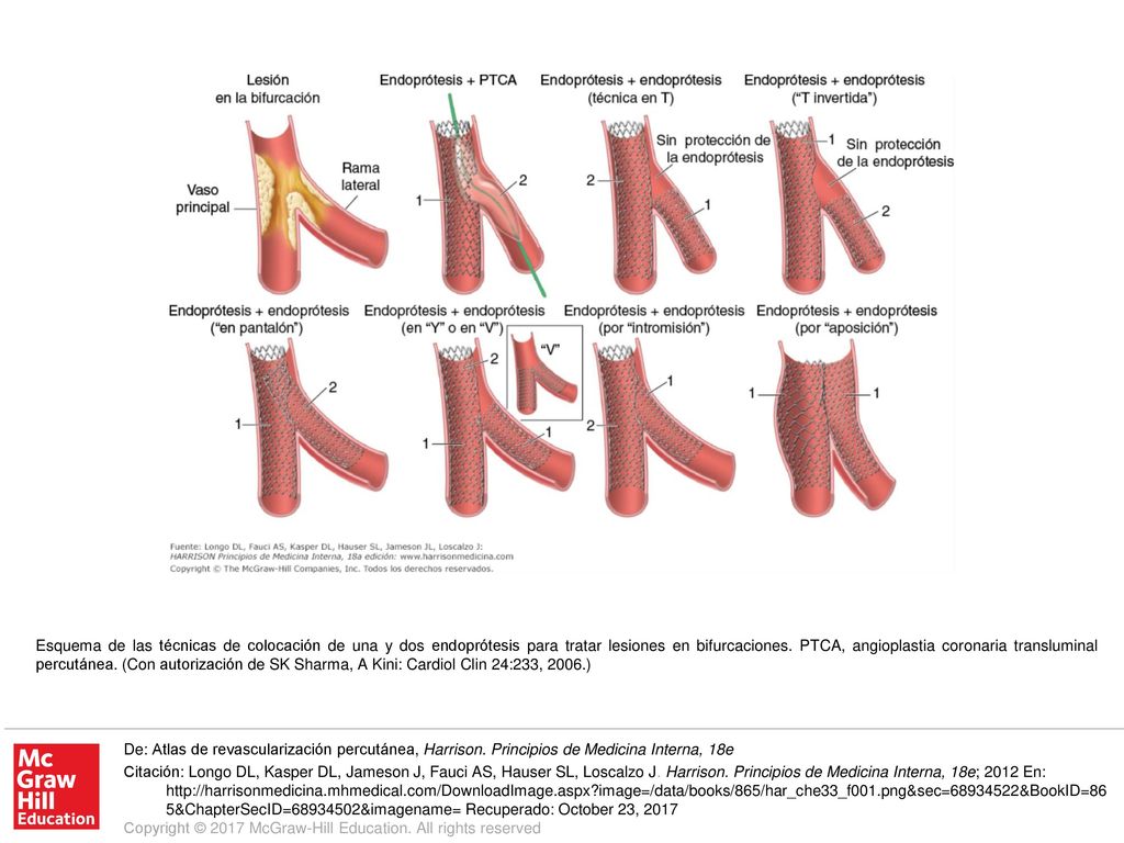 Esquema de las técnicas de colocación de una y dos endoprótesis para tratar lesiones en bifurcaciones. PTCA, angioplastia coronaria transluminal percutánea. (Con autorización de SK Sharma, A Kini: Cardiol Clin 24:233, 2006.)