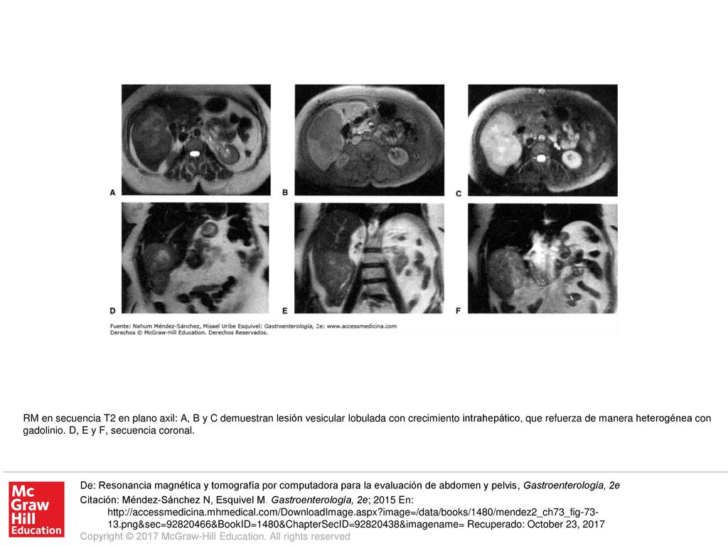 RM en secuencia T2 en plano axil: A, B y C demuestran lesión vesicular lobulada con crecimiento intrahepático, que refuerza de manera heterogénea con gadolinio. D, E y F, secuencia coronal.