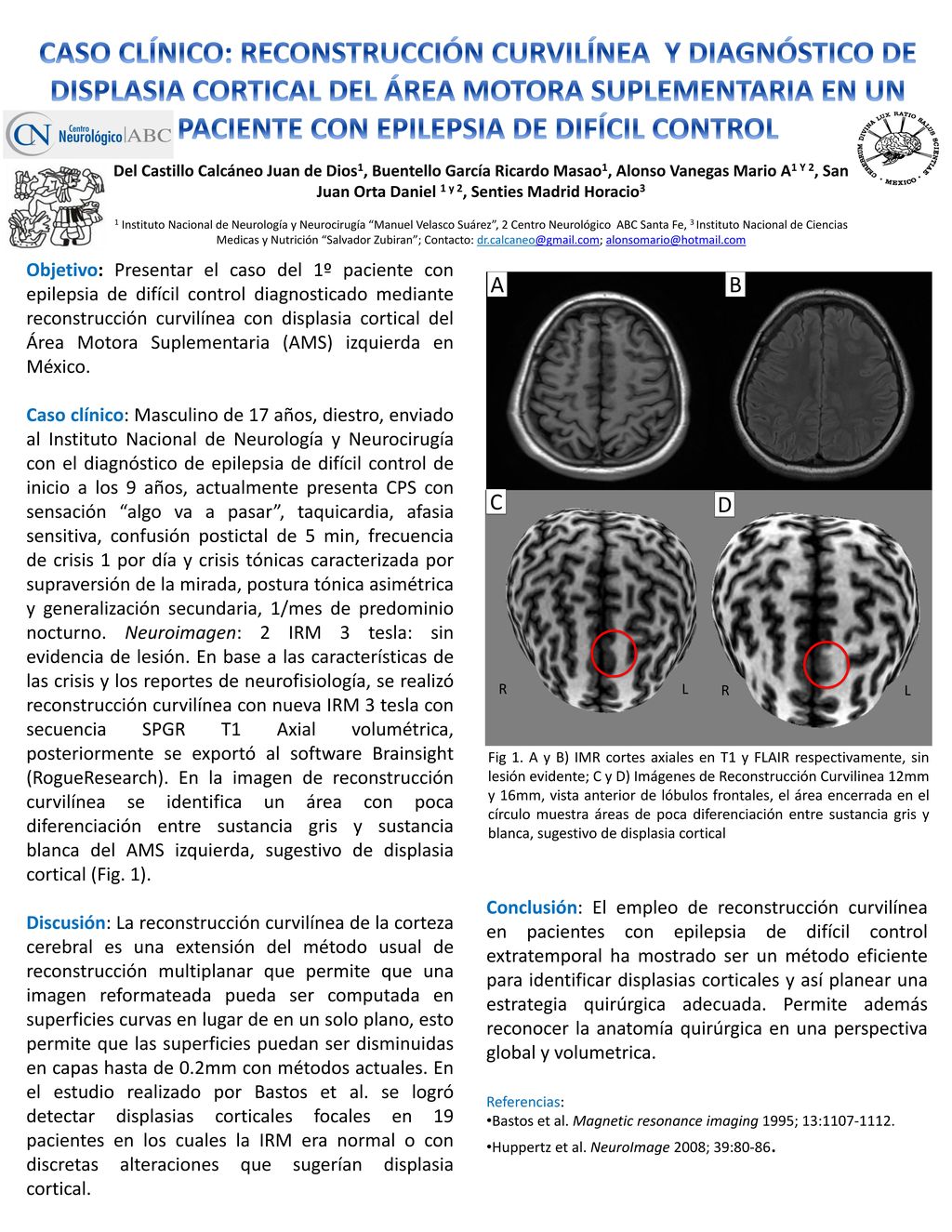 Caso clínico: Reconstrucción Curvilínea y diagnóstico de displasia cortical del ÁREA MOTORA SUPLEMENTARIA en un paciente con epilepsia de difícil control